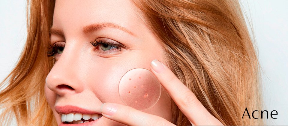 Tratamento por Assunto Acne Estética Modelle