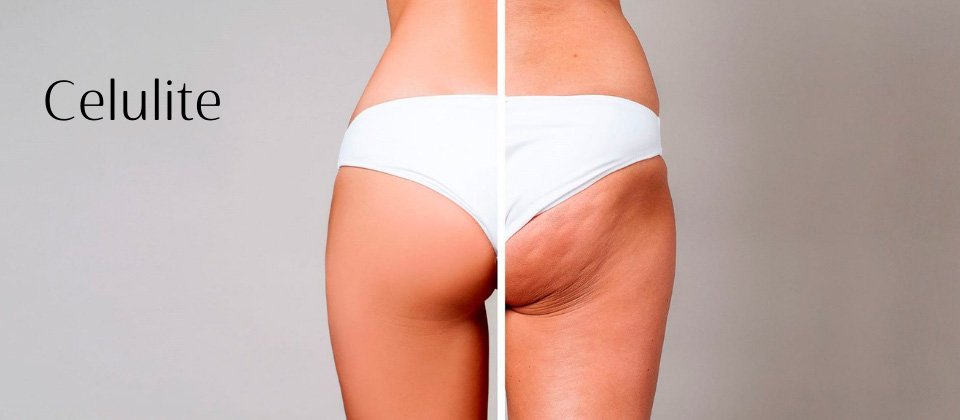Tratamentos por Assunto Celulite Estética Modelle